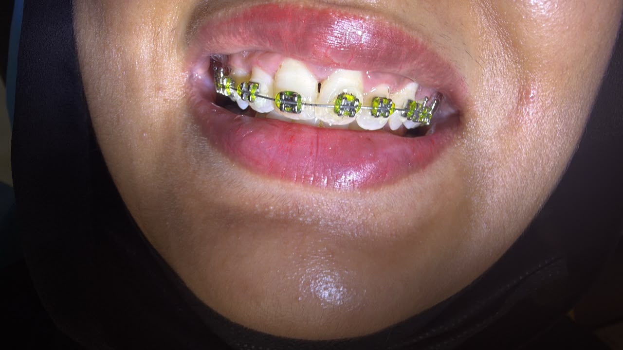Dental treatment at Gulfam Dental Clinic